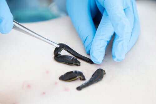 sülük uygulayan doktor